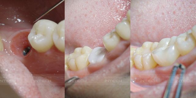 Sai lầm phổ biến khi trồng răng implant - Ảnh 4.