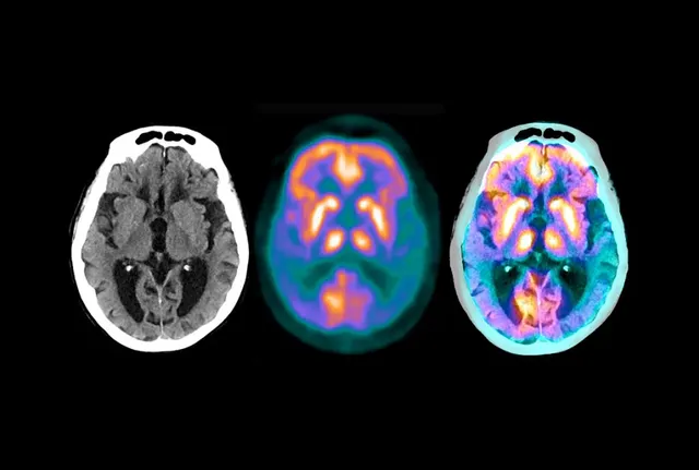 Phương pháp điều trị bệnh Alzheimer thử nghiệm của Eli Lilly làm giảm amyloid - Ảnh 1.