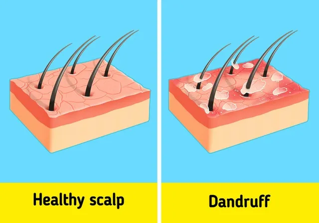 Tại sao da đầu lại có gàu và có cách loại bỏ nó không? - Ảnh 1.