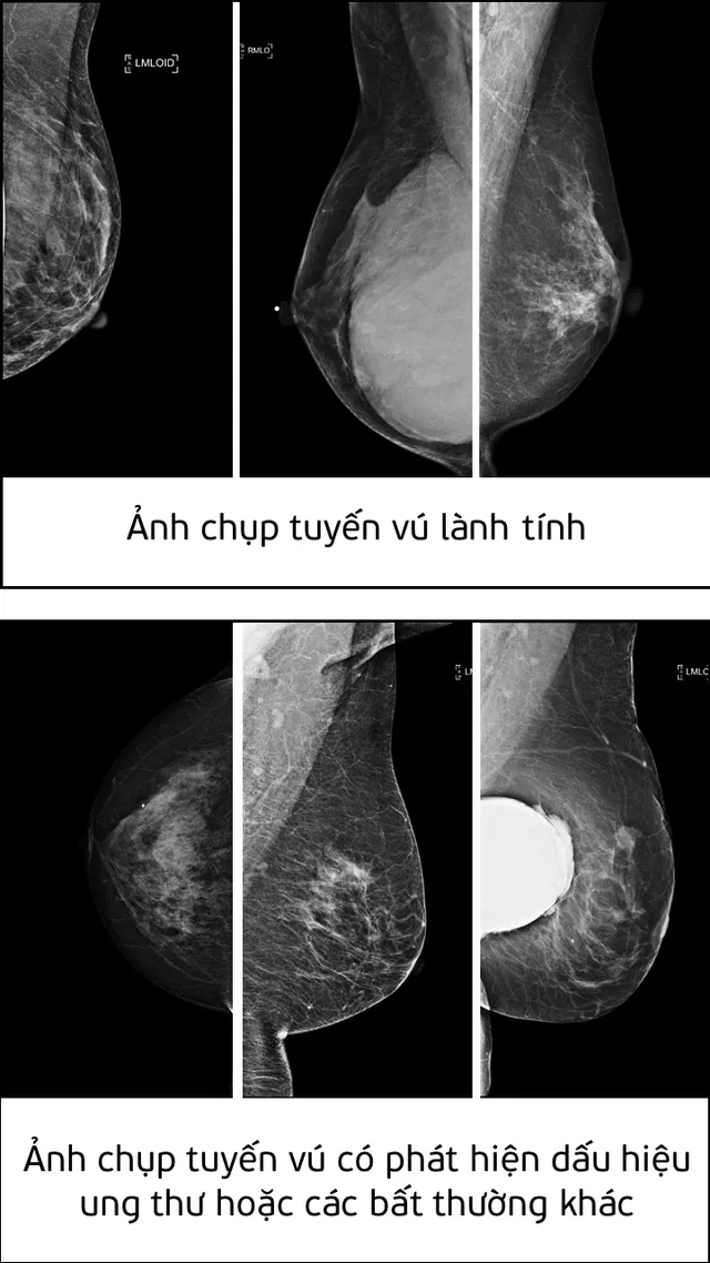 Chuyên gia Viettel chiến thắng cuộc thi AI thế giới với giải pháp phát hiện ung thư tuyến vú - Ảnh 2.