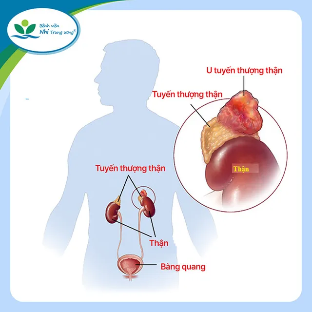 Phẫu thuật thành công u tủy tuyến thượng thận 2 bên hiếm gặp, cứu sống bệnh nhi 14 tuổi - Ảnh 1.