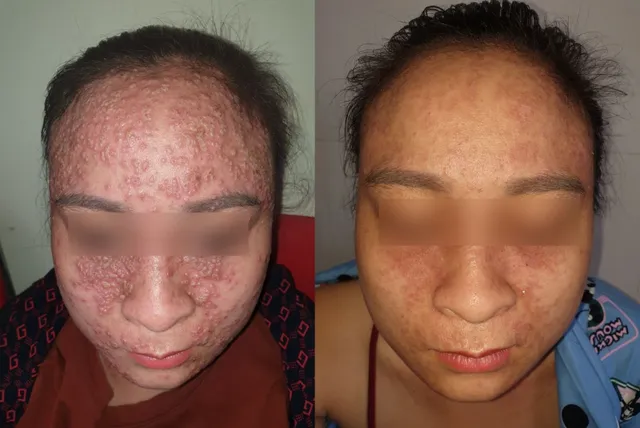 Eczema và nhiều nguy cơ tiềm ẩn - Ảnh 1.