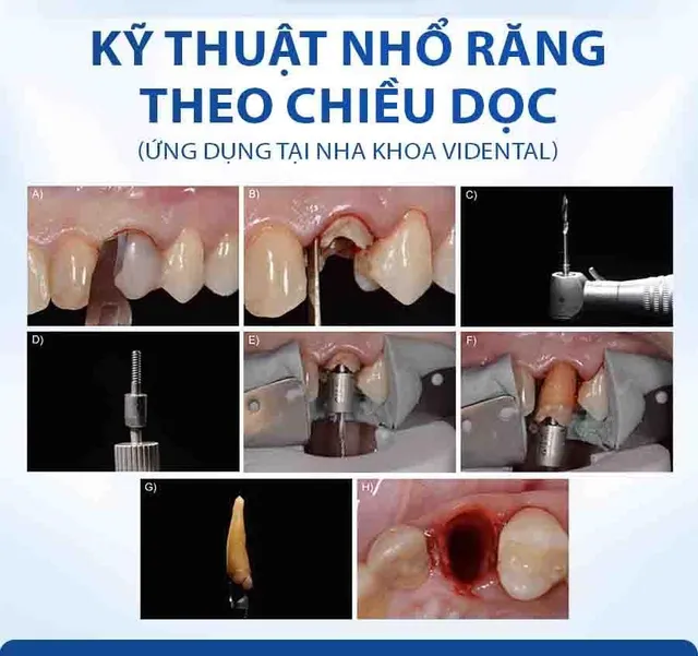 Đánh giá kỹ thuật nhổ răng khôn xâm lấn tối thiểu tại nha khoa ViDental - Ảnh 2.