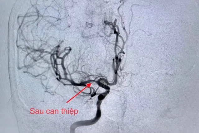 Cứu sống bệnh nhân cùng lúc bị nhồi máu cơ tim và đột quỵ - Ảnh 2. Cứu sống bệnh nhân cùng lúc bị nhồi máu cơ tim và đột quỵ - Ảnh 2.