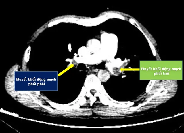 Liên tiếp cấp cứu các ca thuyên tắc động mạch phổi cấp: Cẩn trọng với sát thủ ẩn mình - Ảnh 1.