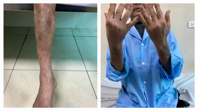 Suy tuyến thượng thận do điều trị bằng thuốc không rõ nguồn gốc tại nhà - Ảnh 1. Suy tuyến thượng thận do điều trị bằng thuốc không rõ nguồn gốc tại nhà - Ảnh 1.