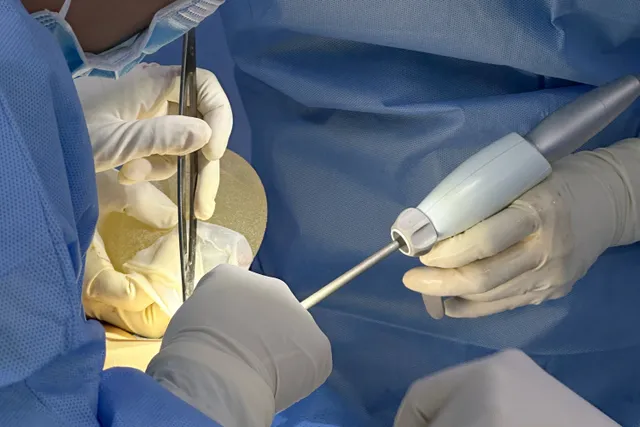 Breast augmentation with Harmo-5K Technology: A safe, painless, and bloodless solution - Ảnh 4.