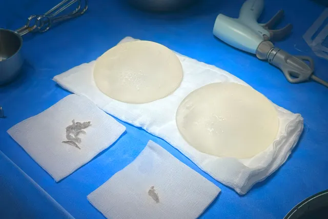 Dr. Ho Cao Vu shares breast implant removal complications - Ảnh 2.