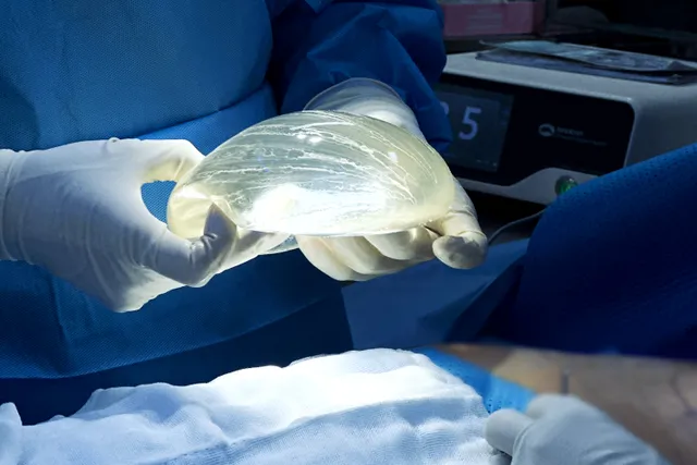 Dr. Ho Cao Vu shares breast implant removal complications - Ảnh 1.