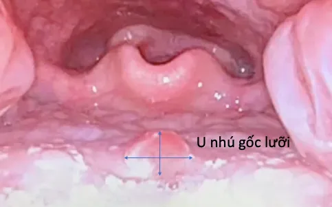 Lạc sản niêm mạc dạ dày - bệnh cảnh hiếm gặp