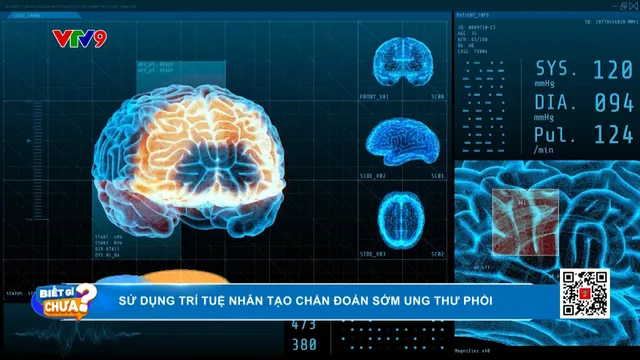 Sử dụng AI chẩn đoán sớm ung thư phổi