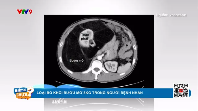 Loại bỏ khối bướu mỡ nặng 8kg khiến người đàn ông nhầm tưởng “bụng bia”