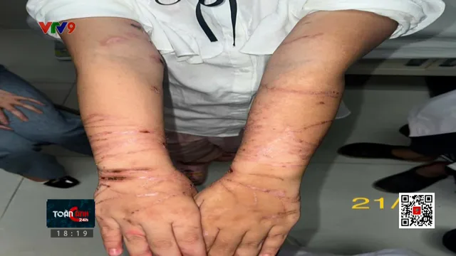 Bé gái chằng chịt vết thương vì dính vào sứa biển