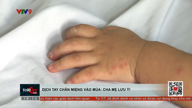 Dịch chân tay miệng vào mùa: Cha mẹ lưu ý