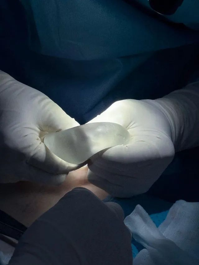 Recurrent Breast Ptosis: Signs, Challenges, and Treatment - Ảnh 3.