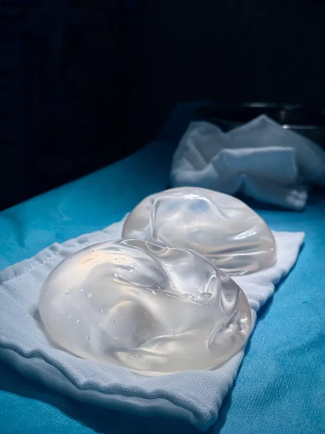 Recurrent Breast Ptosis: Signs, Challenges, and Treatment - Ảnh 2.