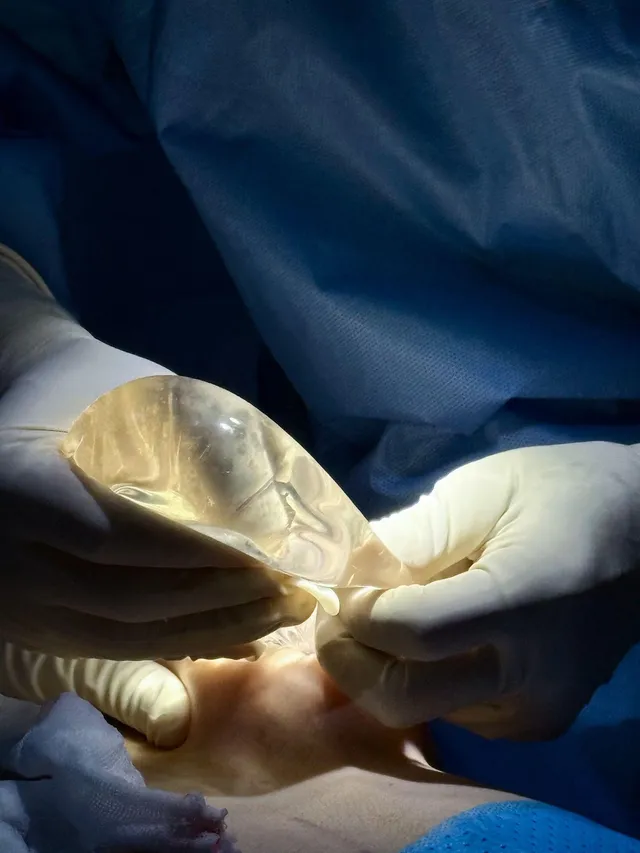 Recurrent Breast Ptosis: Signs, Challenges, and Treatment - Ảnh 1.