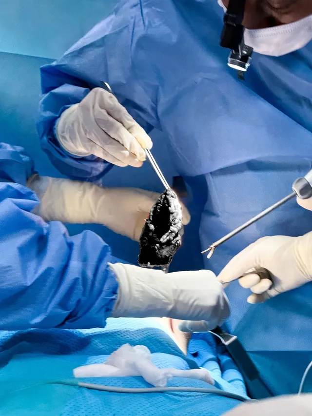 Breast Augmentation Complications: Capsular Contracture, Implant Rupture, Infection - Ảnh 3.