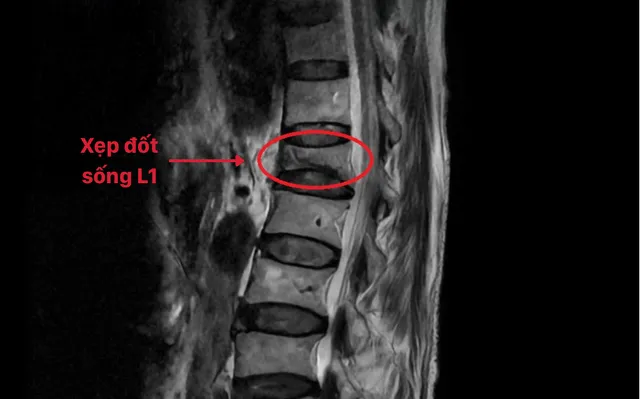 Xẹp đốt sống chỉ sau một lần hắt hơi- Ảnh 1. Xẹp đốt sống chỉ sau một lần hắt hơi- Ảnh 1.