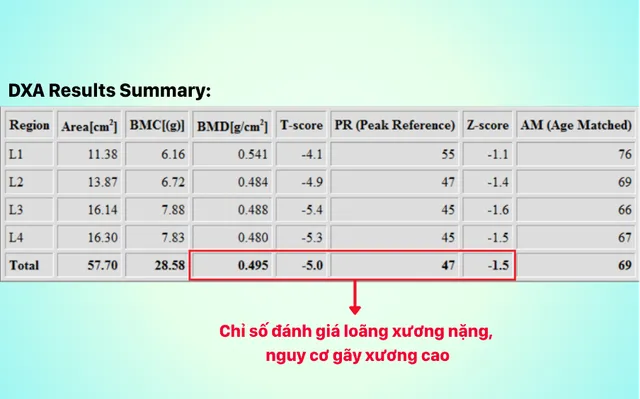 Xẹp đốt sống chỉ sau một lần hắt hơi- Ảnh 2. Xẹp đốt sống chỉ sau một lần hắt hơi- Ảnh 2.