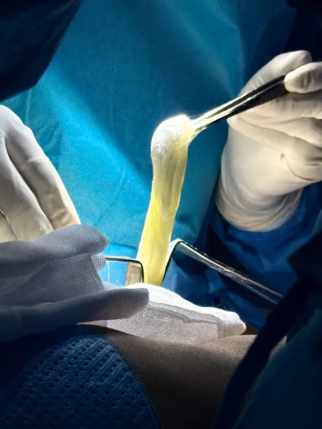 What Is Breast Implant Rupture? - Ảnh 3.