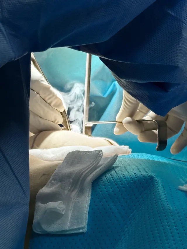 What Is Breast Implant Rupture? - Ảnh 4.