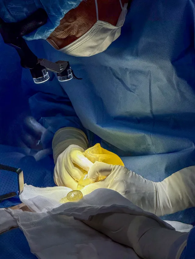 What Is Breast Implant Rupture? - Ảnh 5.