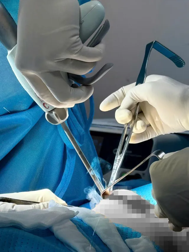 What is recurrent capsular contracture? - Ảnh 5.