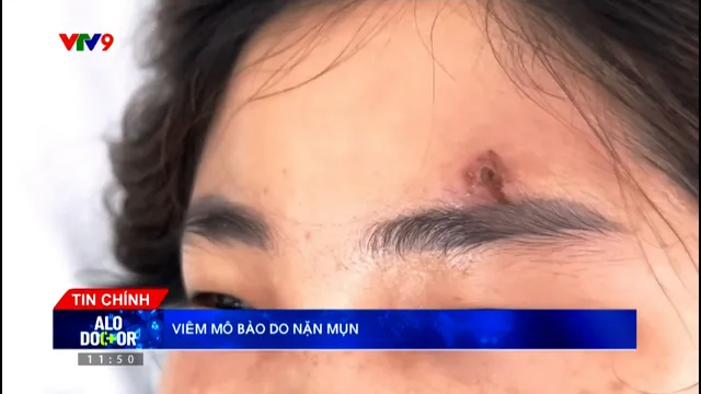 Alo Doctor (28/6/2025): Viêm mô bào từ nặn mụn