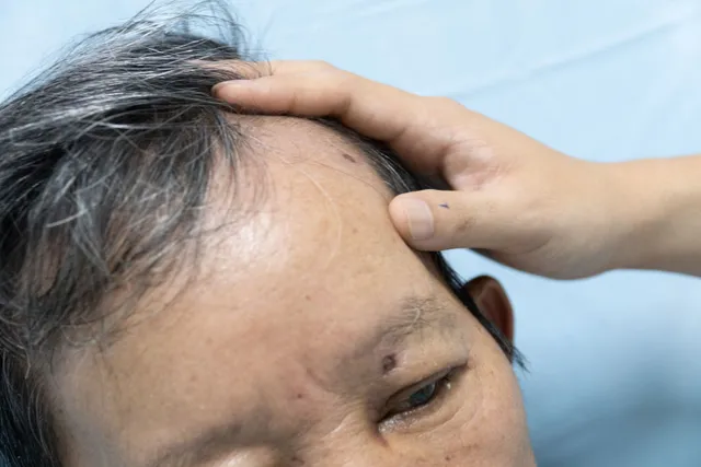 Sống sót kỳ diệu sau khi bị ong vò vẽ đốt hơn 30 vết, hôn mê nguy kịch- Ảnh 1.