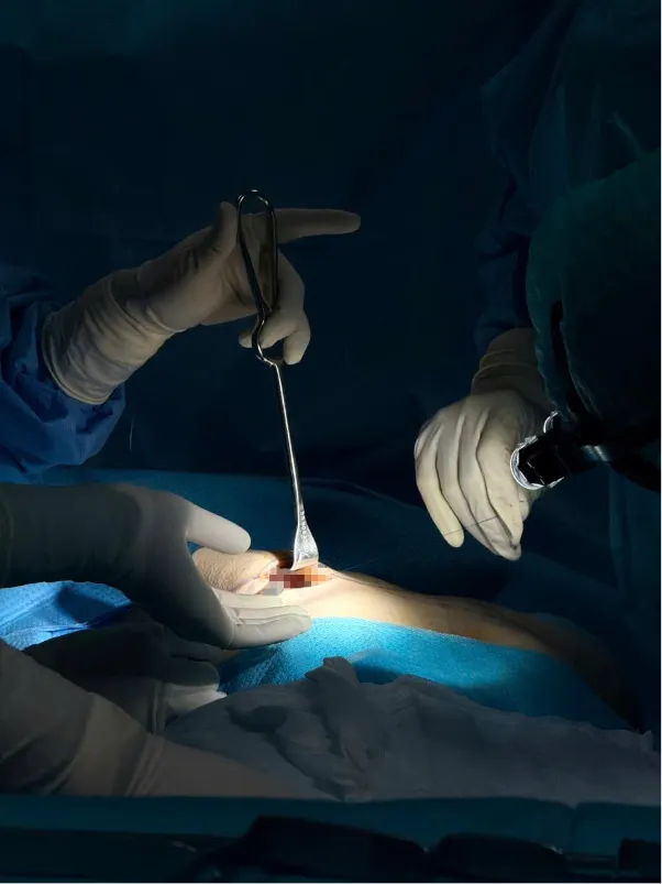 Breast firmness after augmentation: Signs, causes, and treatment - Ảnh 4.