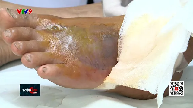 Nguy kịch do dùng thuốc nam chữa rắn độc cắn