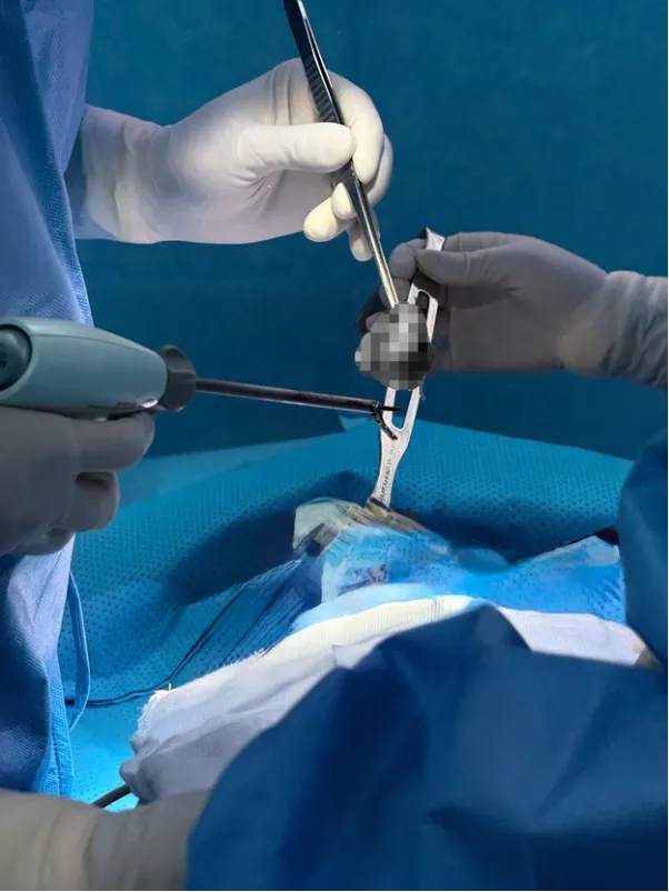 Breast tumor excision combined with implant placement - Ảnh 3.
