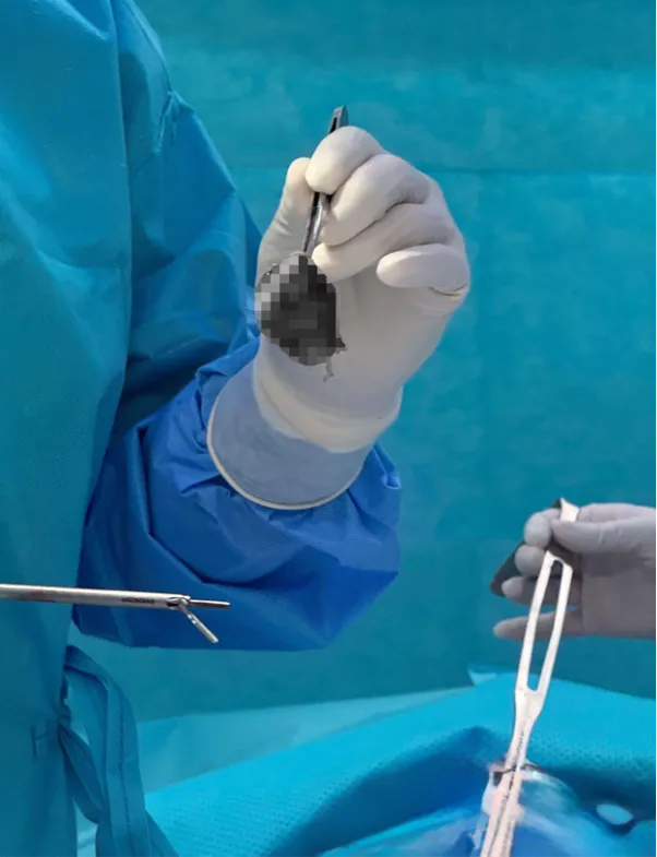 Breast tumor excision combined with implant placement - Ảnh 2.
