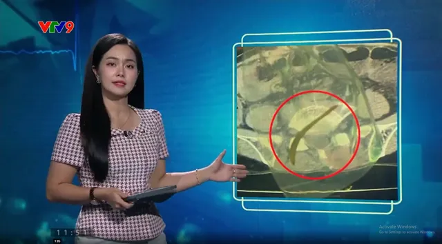 Alo Doctor (19/7/2025): Thủng ruột vì xương cá