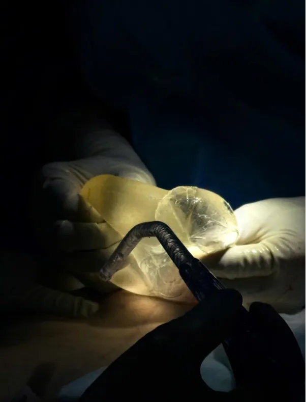 Breast Implant Explantation in Elderly Patients - Ảnh 5.