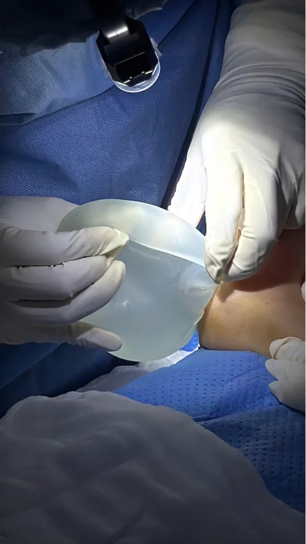 Breast Implant Explantation in Elderly Patients - Ảnh 4.