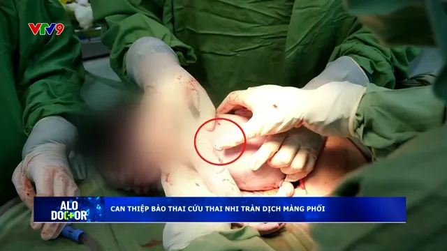Alo Doctor (26/10/2025): Can thiệp bào thai cứu thai nhi tràn dịch màng phổi
