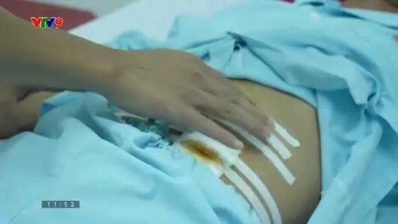 Alo Doctor (14/11/2025): Phát hiện vi khuẩn gây nhiễm trùng vết mổ