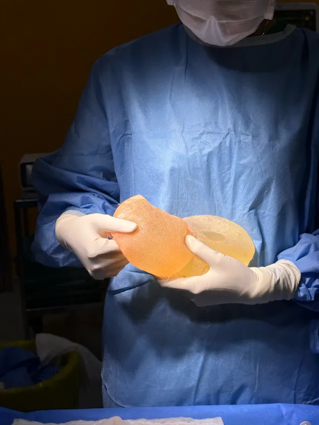 Dissection Technique and LMA Anesthesia for Breast Implants: The Optimal Solution? - Ảnh 2.