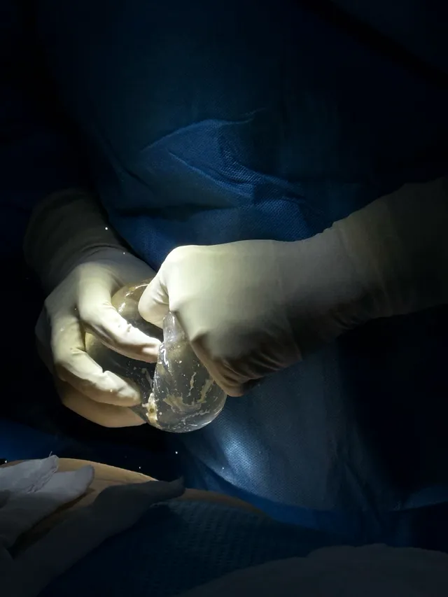 Dissection Technique and LMA Anesthesia for Breast Implants: The Optimal Solution? - Ảnh 3.