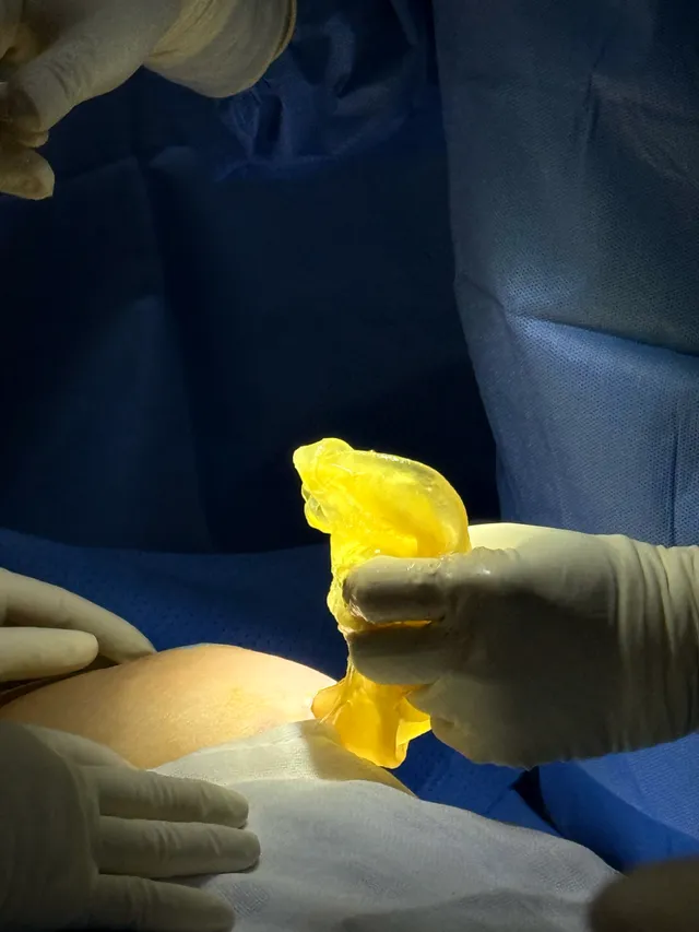 Dissection Technique and LMA Anesthesia for Breast Implants: The Optimal Solution? - Ảnh 4.