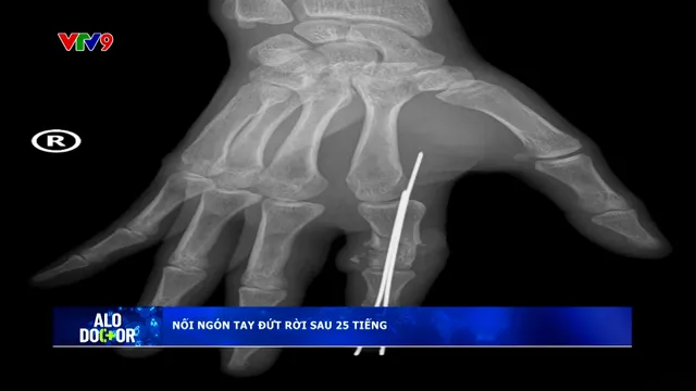 Alo Doctor (10/12/2025): Nối ngón tay đứt rời sau 25 tiếng