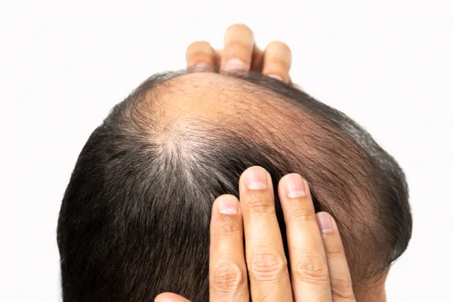 Tổng thống Hàn Quốc Lee Jae Myung gây tranh luận về đề xuất bảo hiểm chi trả điều trị rụng tóc- Ảnh 1. Tổng thống Hàn Quốc Lee Jae Myung gây tranh luận về đề xuất bảo hiểm chi trả điều trị rụng tóc- Ảnh 1.