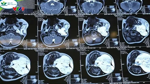 Alo Doctor (30/12/2025): Loại bỏ khối u kích thước lớn cho bé 2 tuổi