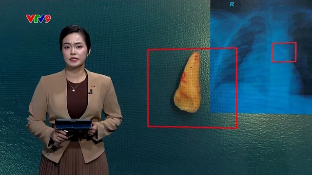 Alo Doctor (31/12/2025): Bé trai khó thở vì răng mắc trong khí quản sau va chạm