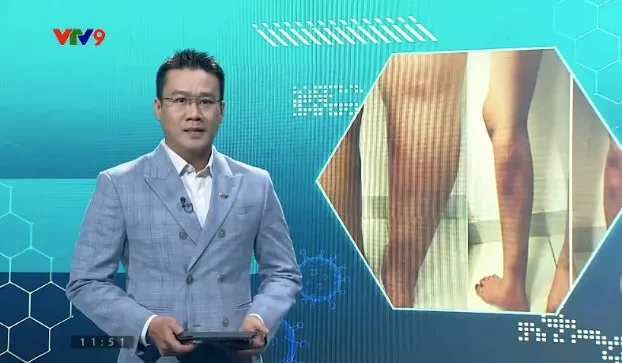 Alo Doctor (10/3/2026): Chân biến dạng sau tiêm filler làm thẳng chân tại nhà