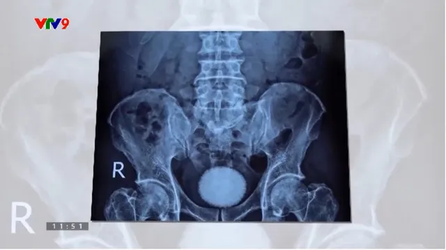 Alo Doctor (16/3/2026): Phẫu thuật lấy viên sỏi bàng quang "khủng" bằng quả trứng ngỗng