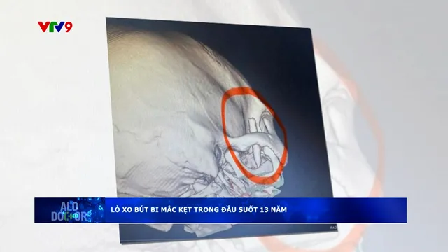 Alo Doctor (19/3/2026): Lò xo bút bi mắt kẹt trong đầu suốt 13 năm