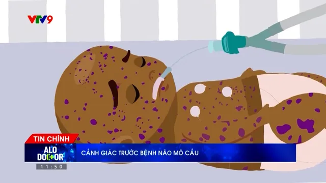 Alo Doctor (26/3/2026): Cảnh giác bệnh não mô cầu gây chết người